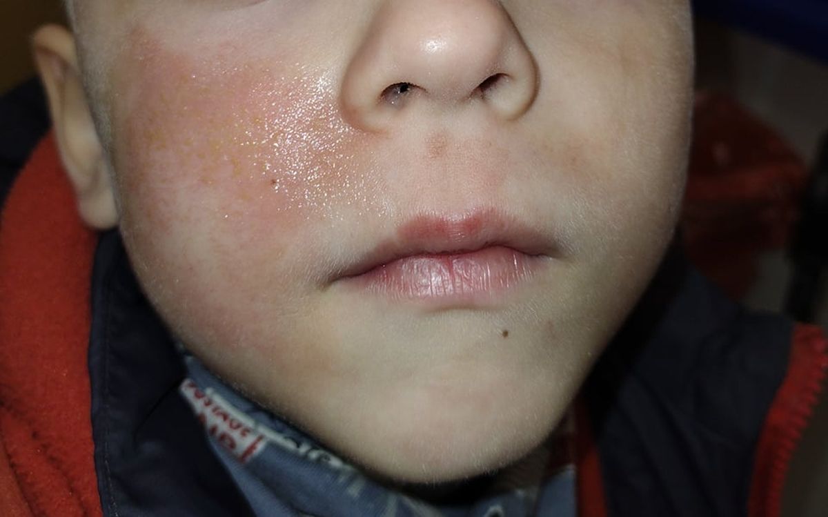 5-latek poparzył w przedszkolu twarz. Dziecko chciało tylko zdezynfekować dłonie
