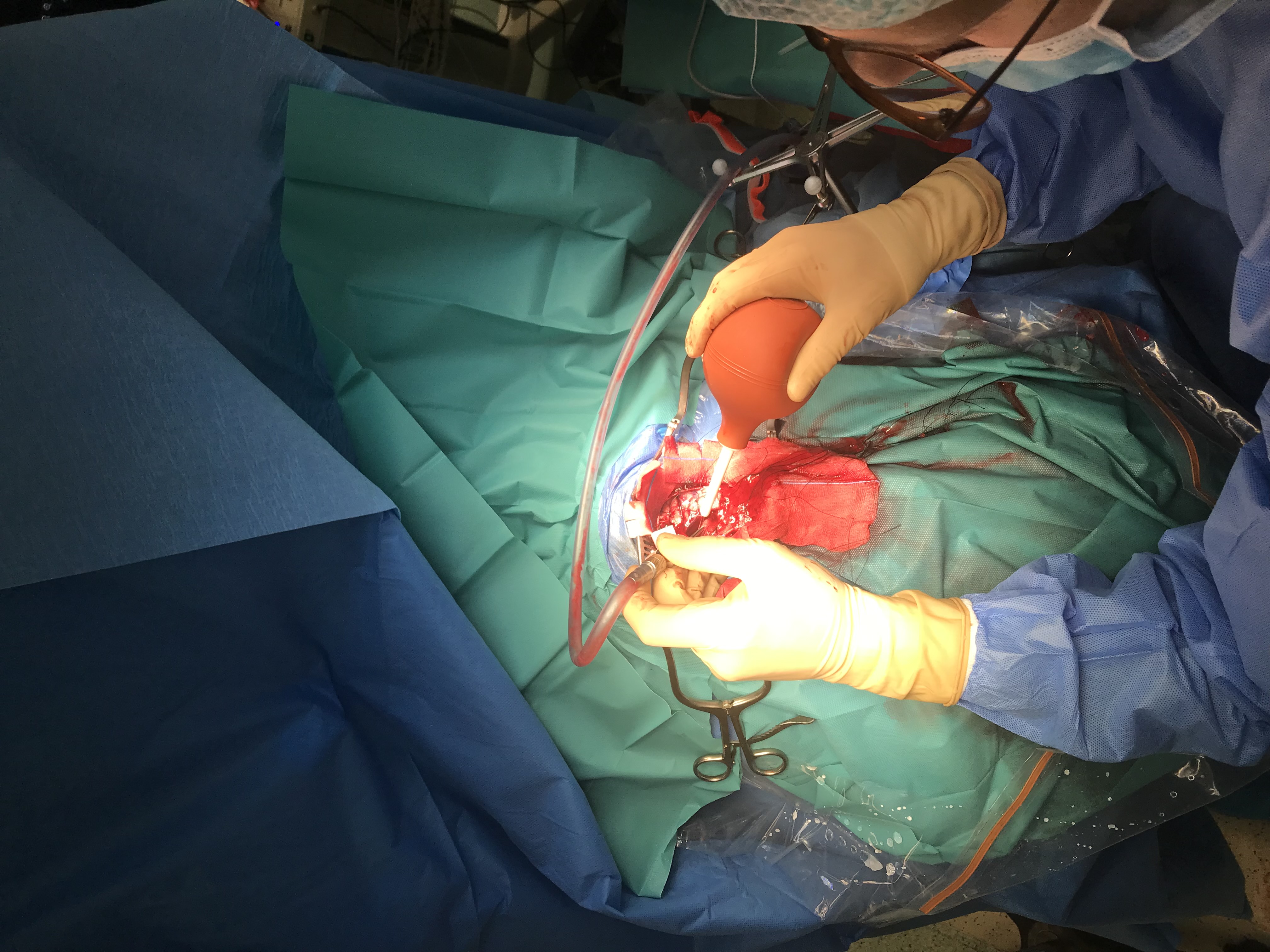 W Lublinie zoperowano pacjentkę z Ukrainy wyjątkową techniką stosowaną podczas trudnych operacji mózgu (zdjęcia)